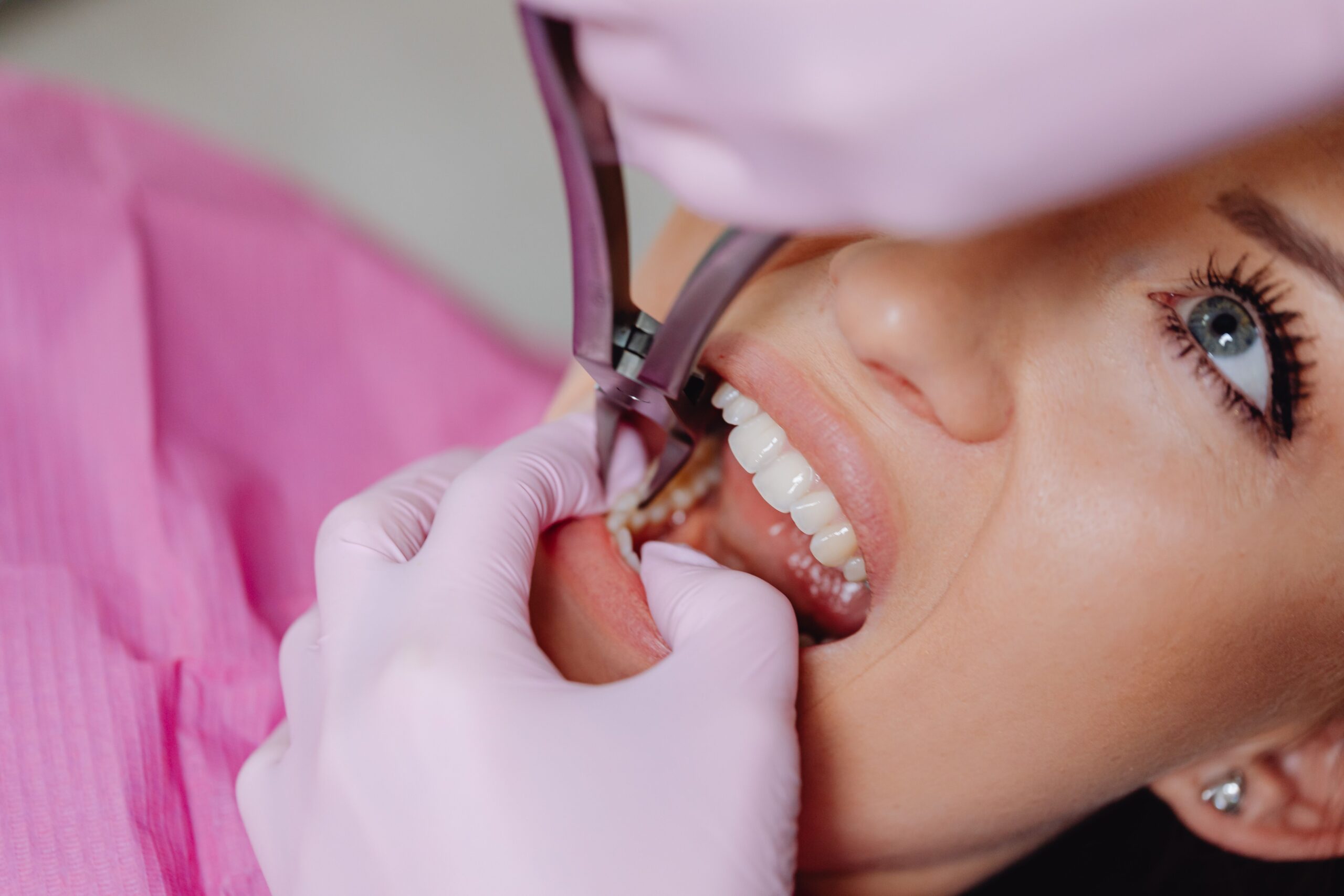 Extrações Dentárias