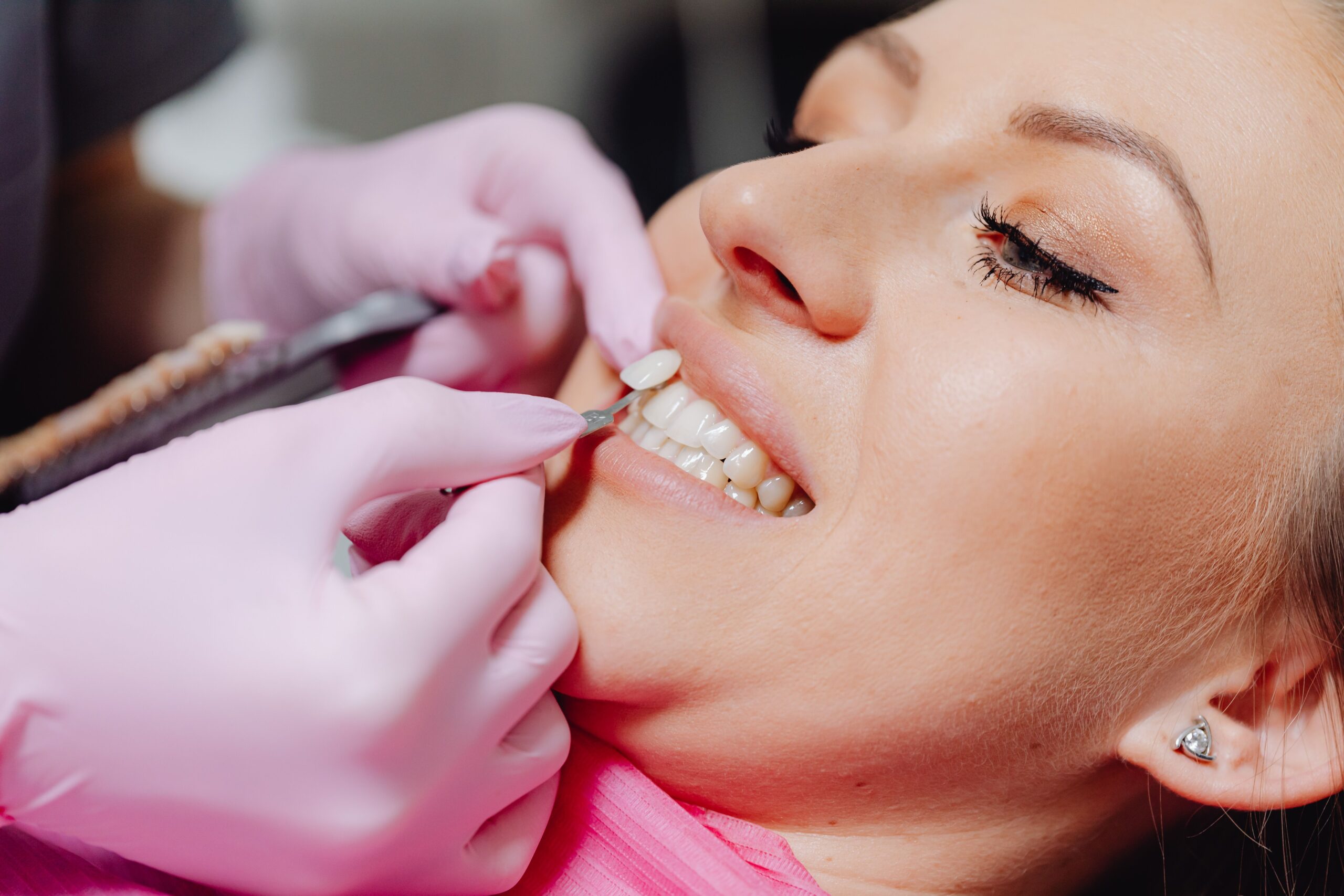 Facetas Dentárias