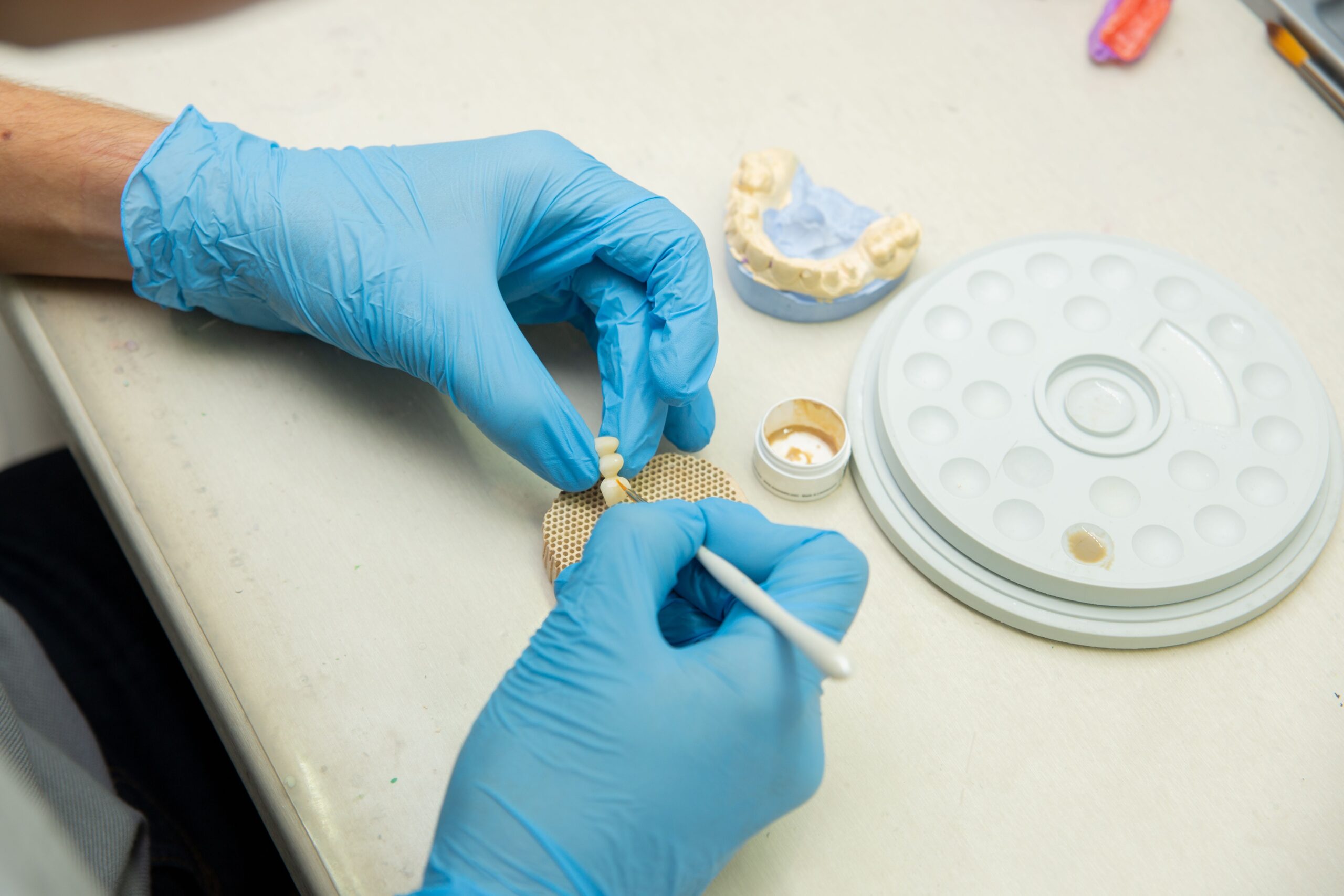 Implantes Dentários